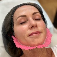 PDO matrix threads | SC Injectables Brisbane